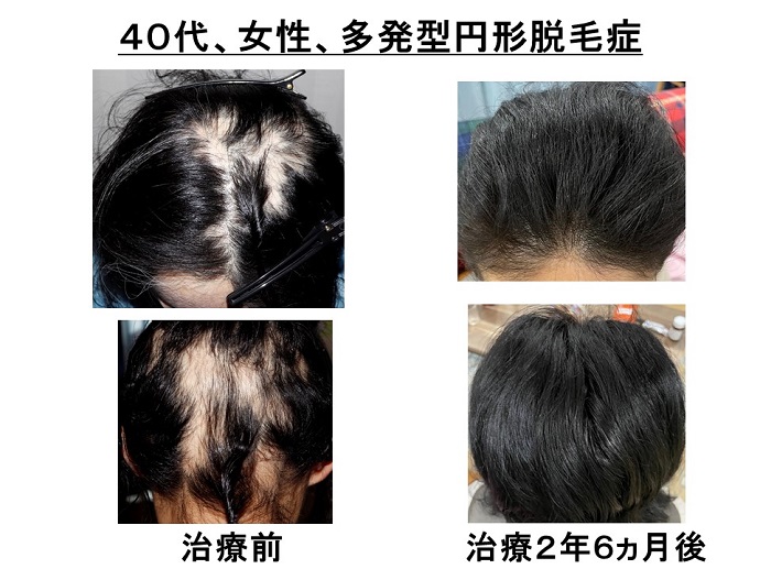 円形脱毛症　病院